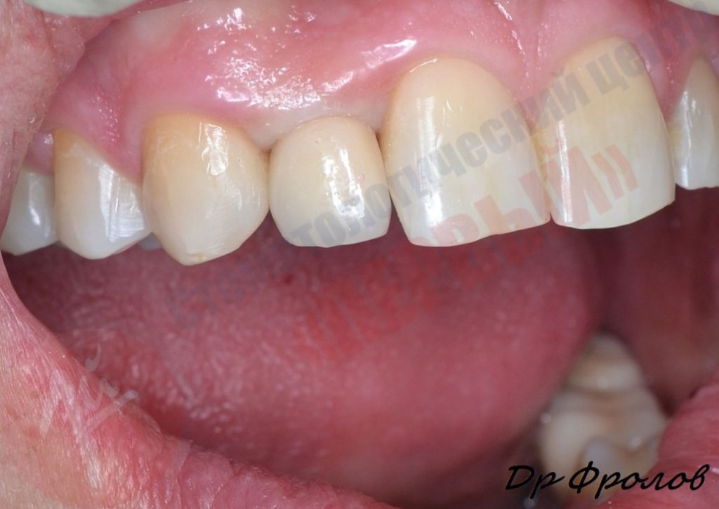 Протезирование дефектных зубных рядов 04