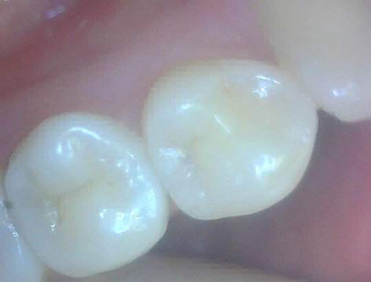 Лечение зубов 4