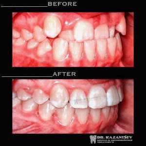 Ортодонтическая коррекция