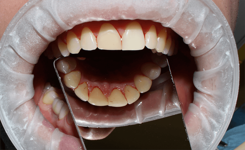 Профессиональная чистка зубов 2
