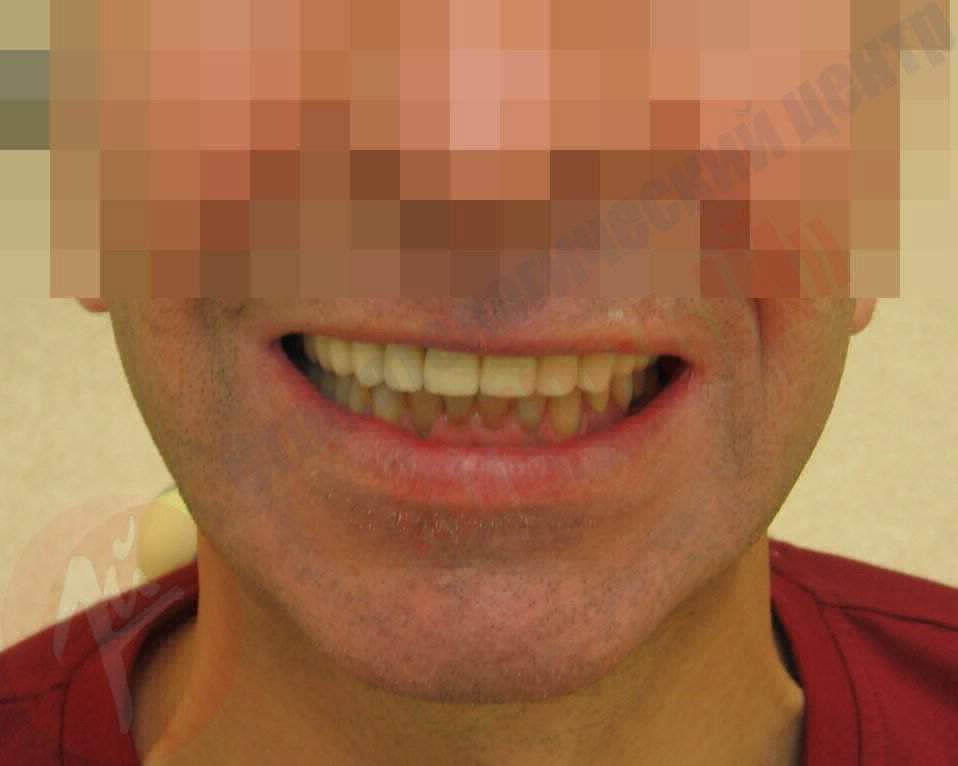 Протезирование зубов 1