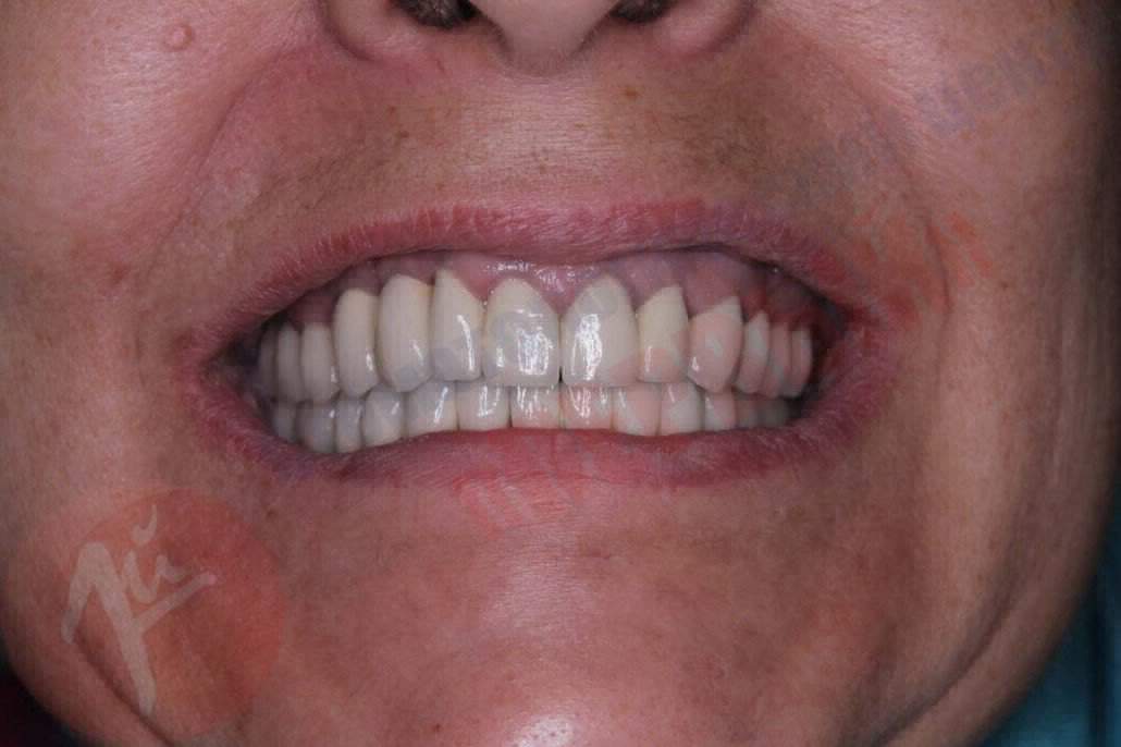 Протезирование зубов 2