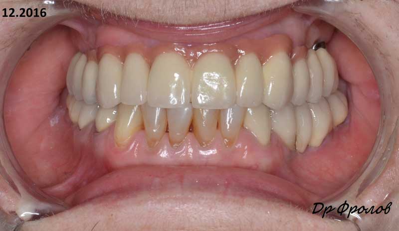 Протезирование зубов 4