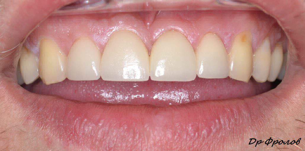 Протезирование зубов 5