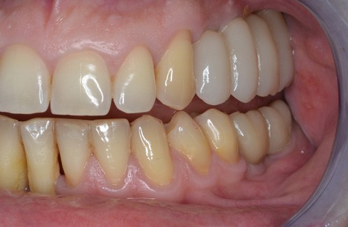 Протезирование жевательной группы зубов