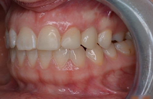 Протезирование зубов 7