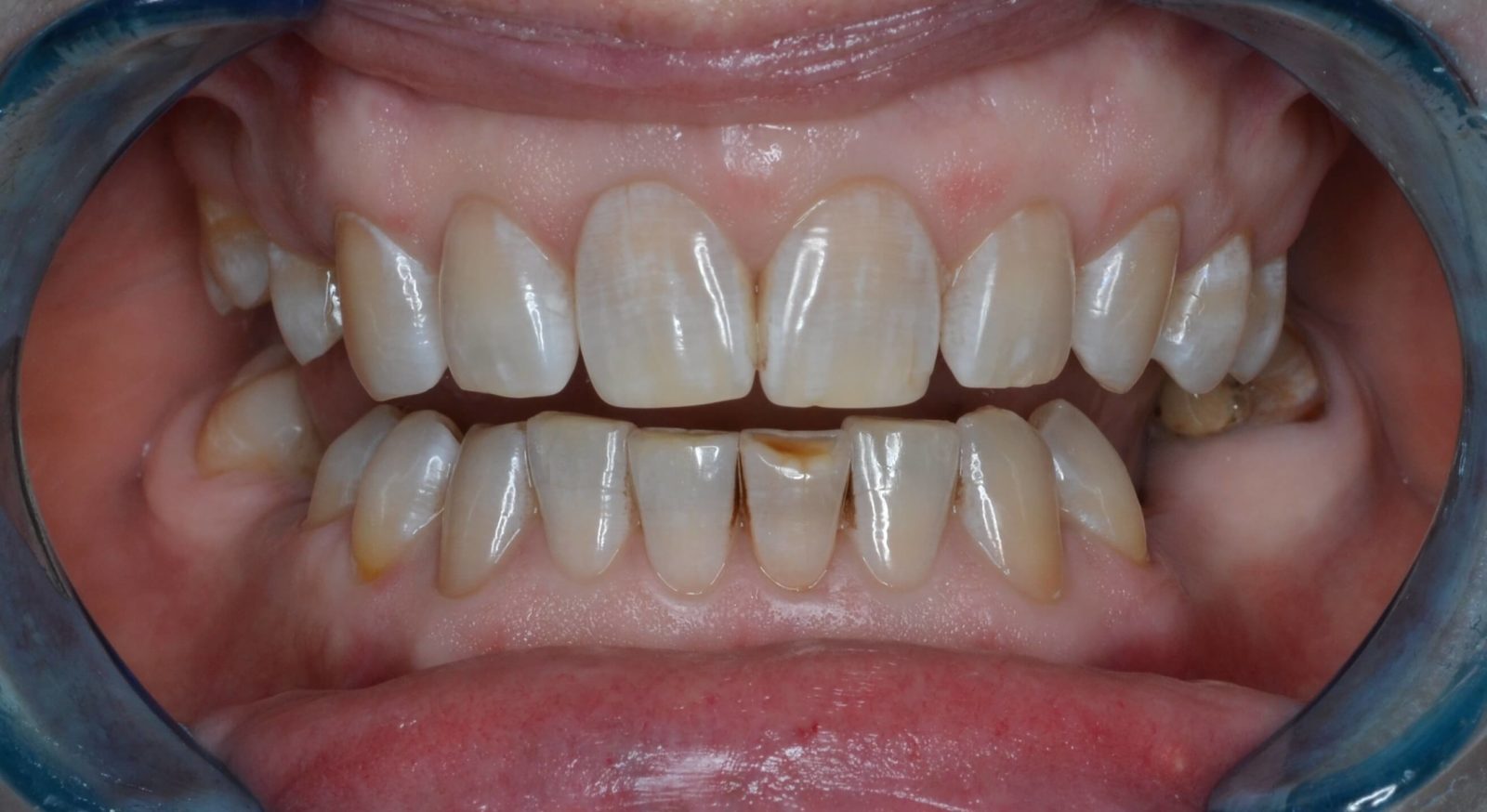Восстановление зубов по технологии CEREC