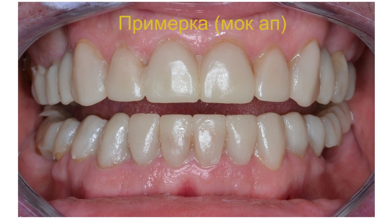 Восстановление целостности зубных рядов