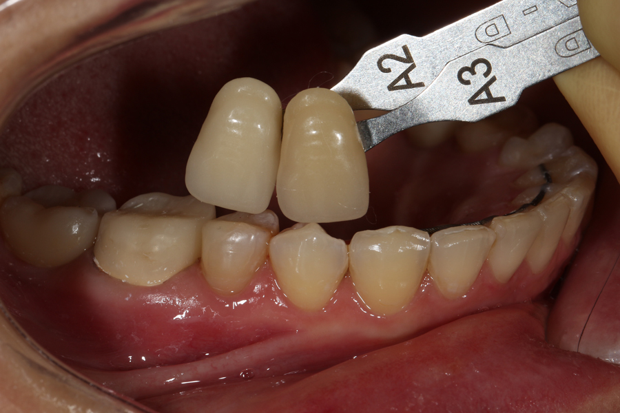 Восстановление трёх жевательных зубов