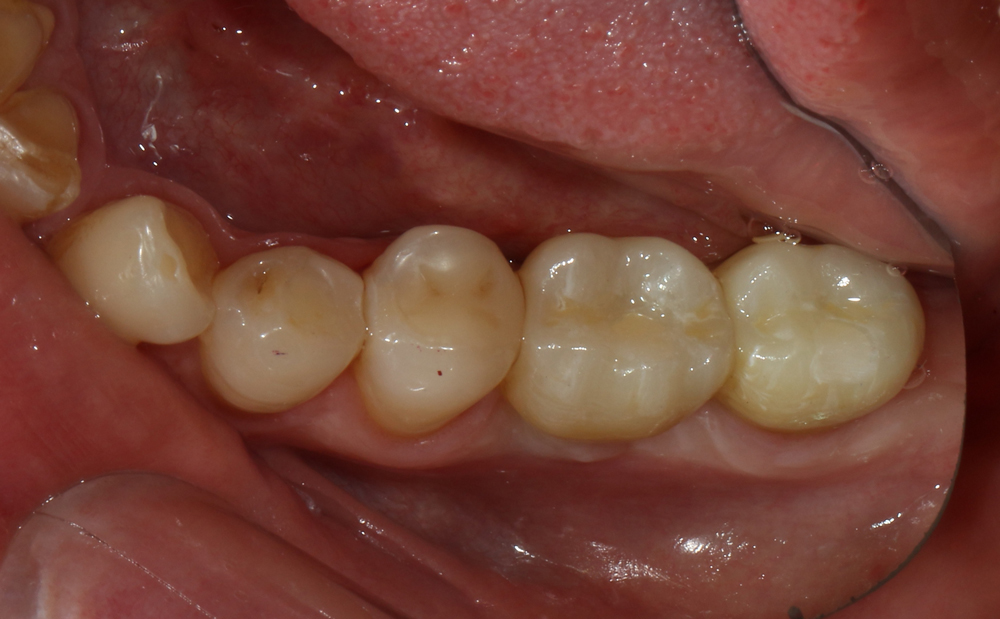 Восстановление жевательной группы зубов